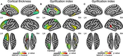 Atypical cortical thickness and folding of language regions in Chinese nonsyndromic cleft lip and palate children after speech rehabilitation